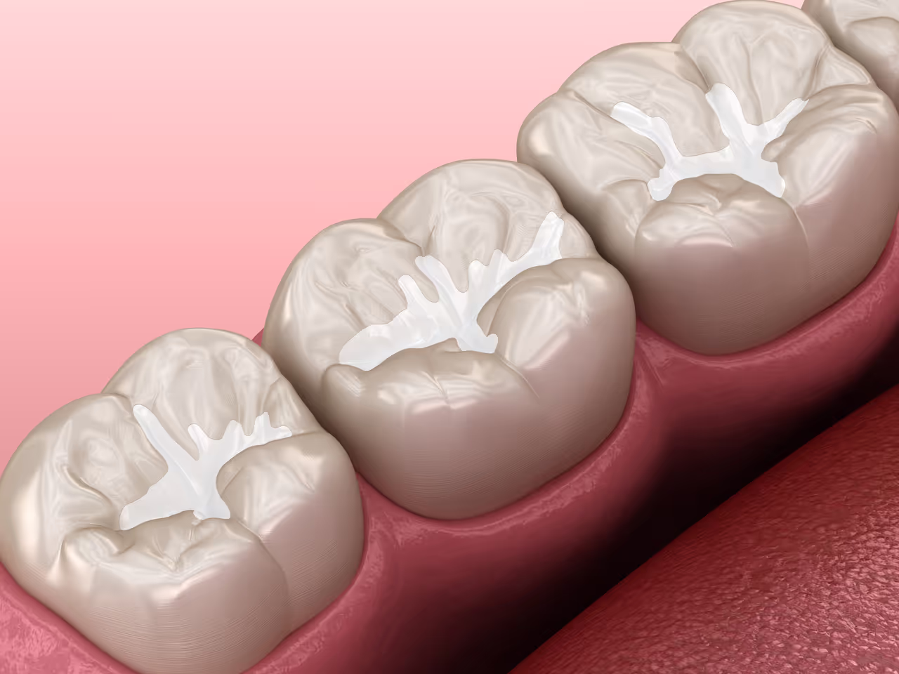 High-Quality, Natural-Looking Dental Fillings at Lakeshore Dental