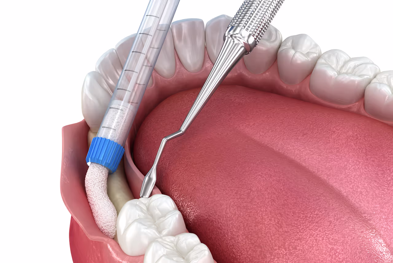 Rebuild and Strengthen Your Jawbone with Bone Grafting at Lakeview Dental