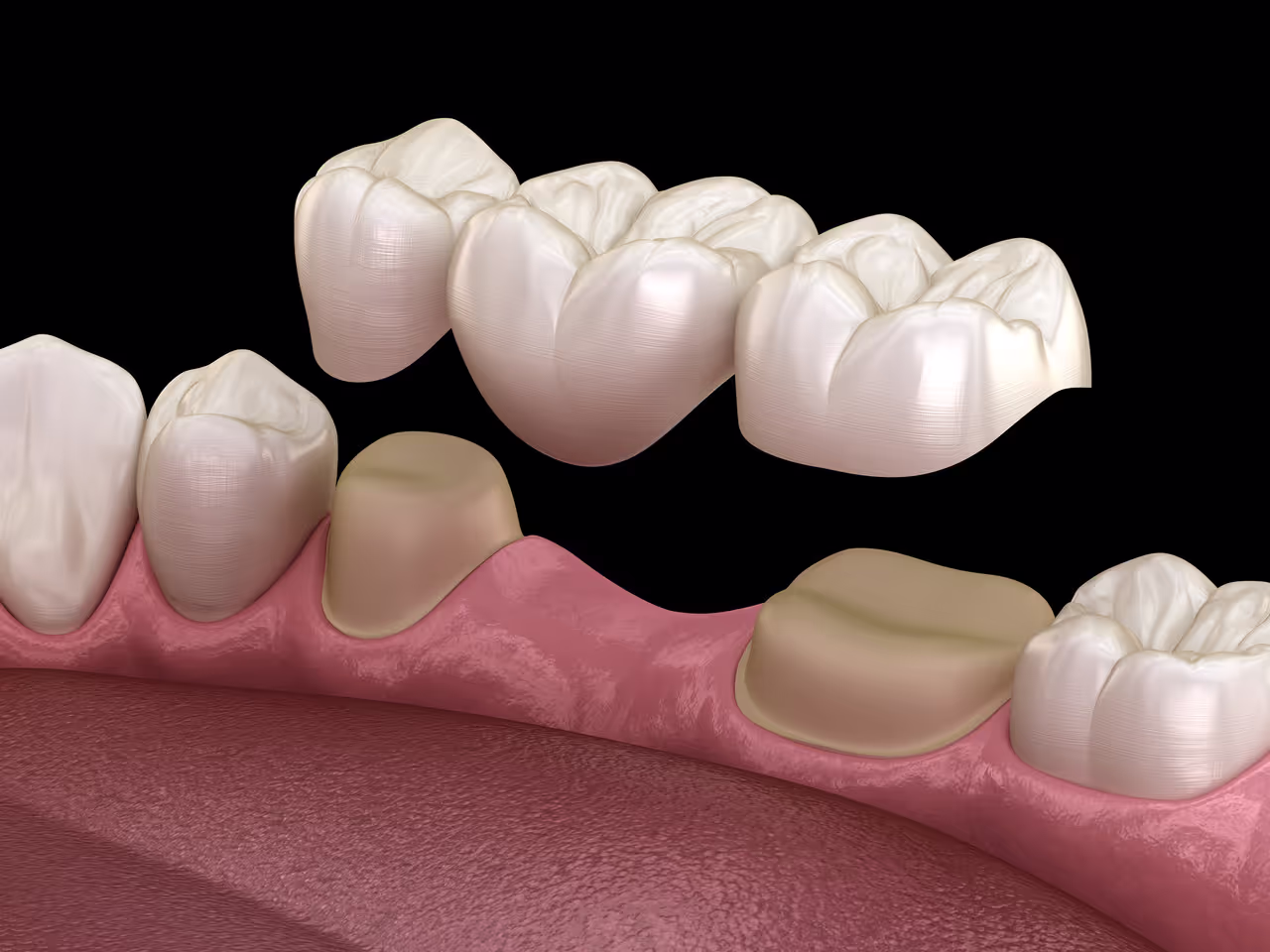 Regain Your Smile and Confidence with Dental Bridges
