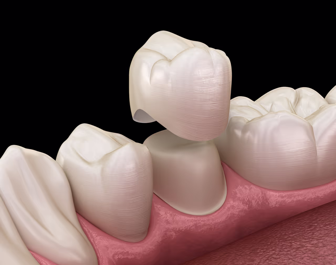 Protect Your Smile with Durable, Natural-Looking Crowns