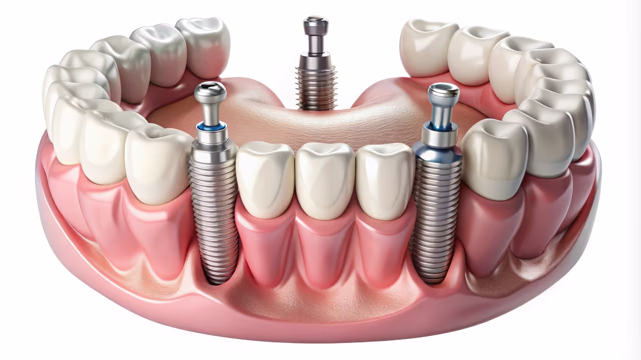 Enjoy a Secure, Confident Smile with Implant Overdentures at Lakeshore Dental